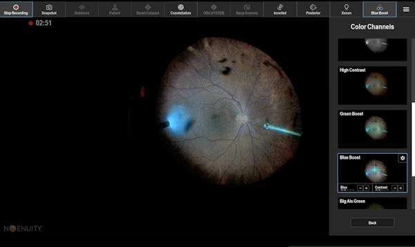 Vitrectomy for floaters with enhanced vitreous 2D (Narrated Case) thumbnail