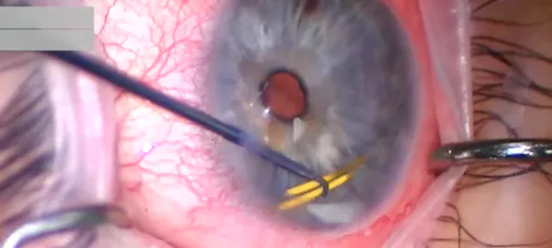 Removal of Migrated Steroid Implant From the Anterior Chamber and Goniotomy Revision