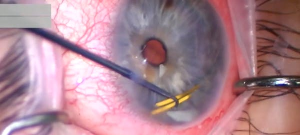 Removal of Migrated Steroid Implant From the Anterior Chamber and Goniotomy Revision thumbnail