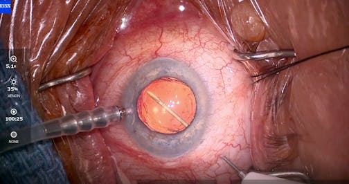 Management of Glaucoma and Floaters