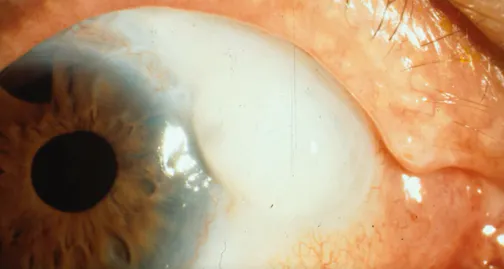 Painful Blebs and Their Management: Compression Sutures and Cautery