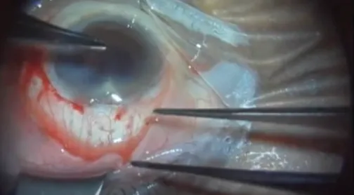 Reconsidering Anatomy in Glaucoma Surgery