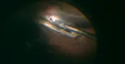 Challenging Cases of Intraocular Foreign Body Removal