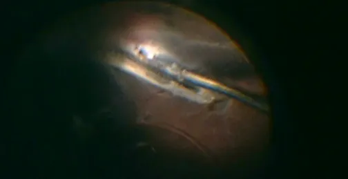 Challenging Cases of Intraocular Foreign Body Removal