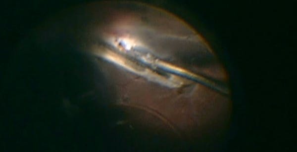 Challenging Cases of Intraocular Foreign Body Removal thumbnail