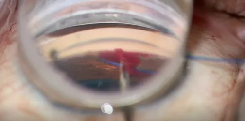 Hemorrhage From Iris Root Trauma During GATT