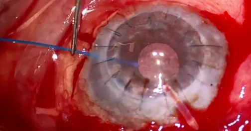Guidewire-Assisted Tube Shunt Placement in the Ciliary Sulcus