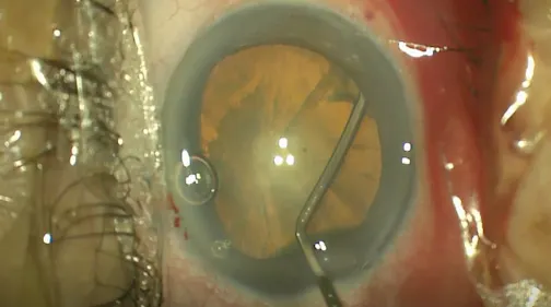 A Rogue Cystotome