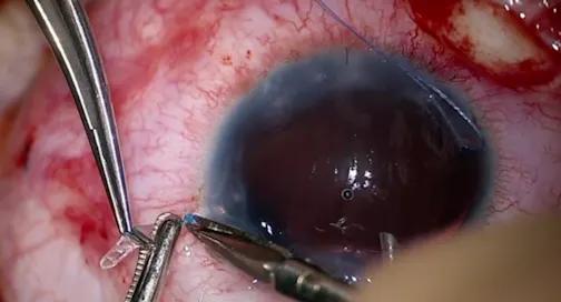 Hypotony After Nonvalved Tube Shunt Surgery