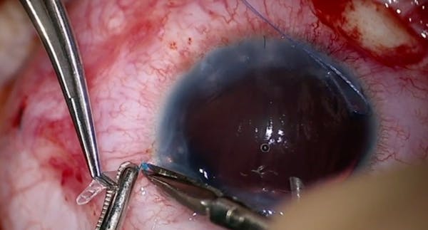 Hypotony After Nonvalved Tube Shunt Surgery thumbnail