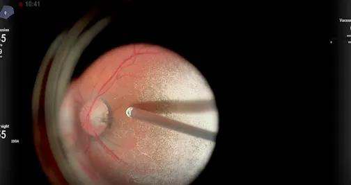A Case of Optic Pit Maculopathy