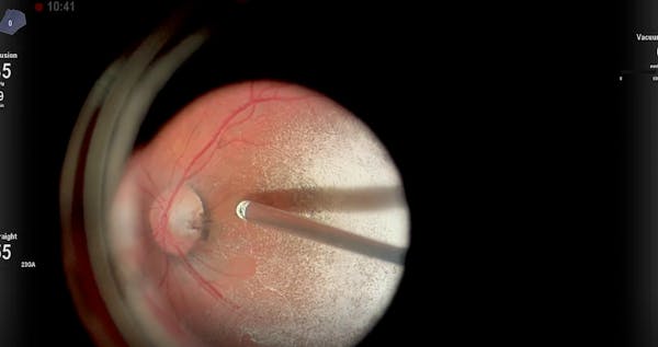 A Case of Optic Pit Maculopathy thumbnail