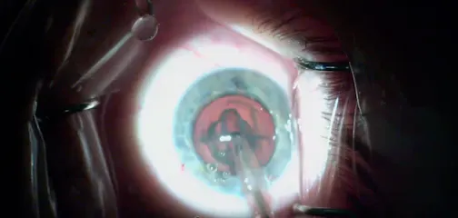 Divide-and-Conquer With Phaco Chop Adaptations