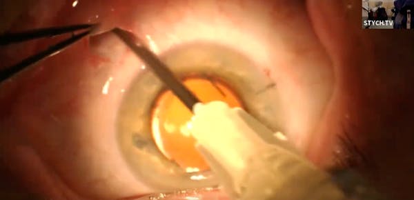 Sub-Tenon Retrobulbar Infusion Technique thumbnail