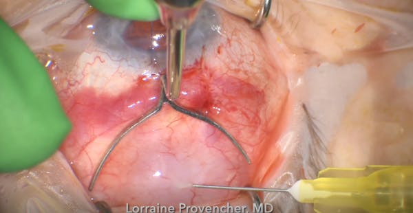 Provencher Barricade for Subconjunctival Injections thumbnail