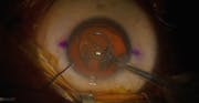 Phacoemulsification Under Intracorneal Ring Segment