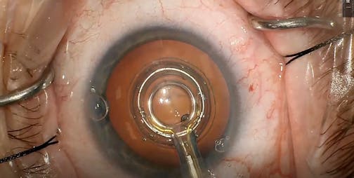 ZEPTOLink Centration Pearls