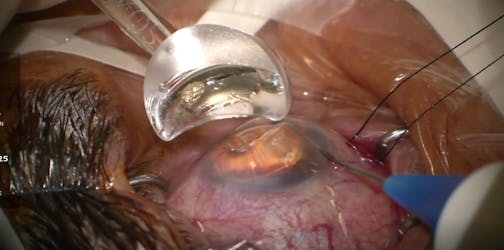 Pressurized Viscodelivery: iTrack Advance Diffuse Blanching