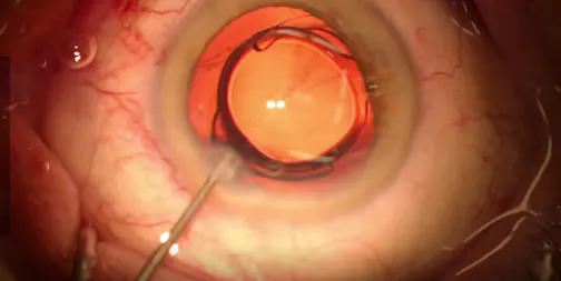 Multifocal IOL Exchange
