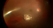 Removing Tempered Glass From the Eye