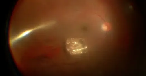Removing Tempered Glass From the Eye