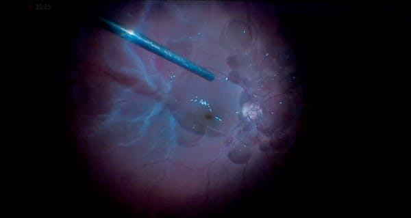 Vitrectomy for PVR-Induced Retinal Detachment With Peripheral Retinotomy, Ensuring Retinal Stability thumbnail