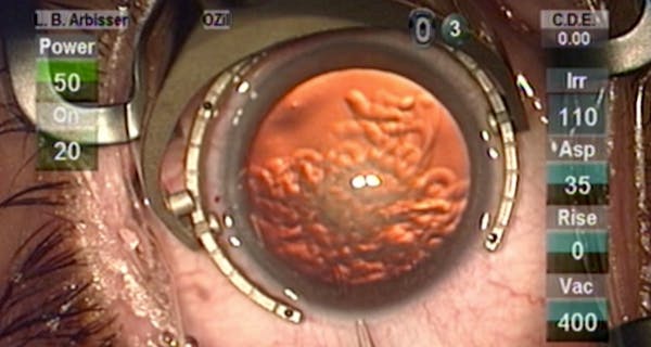 Intraoperative Patient Communication During Cataract Surgery thumbnail