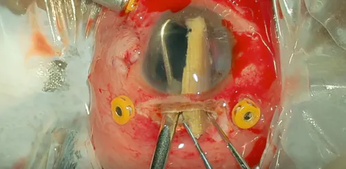Removing an Organic Intraocular Foreign Body