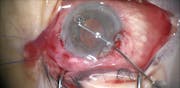 Sulcus Tube Shunt, Synechialysis, and Irido-Zonulo-Hyaloid Vitrectomy