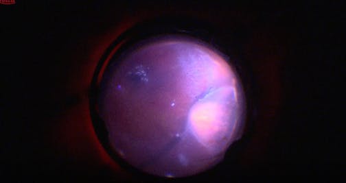 OCT-Assisted Retinal Detachment Repair