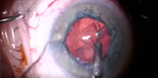 Pseudoexfoliation Zonulopathy: Surgical Approach
