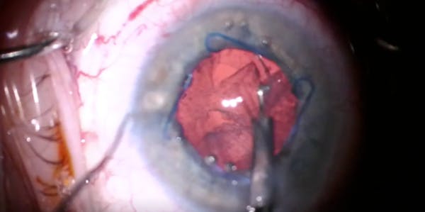 Pseudoexfoliation Zonulopathy: Surgical Approach thumbnail