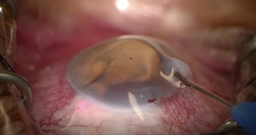 iTrack Titration of Blanching
