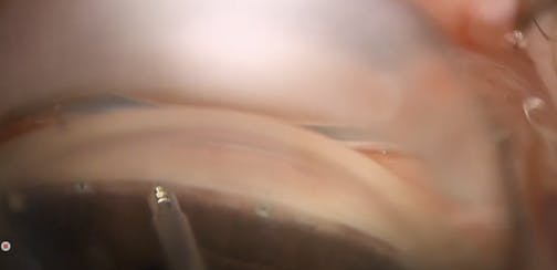 Standalone iStent Infinite and iDose