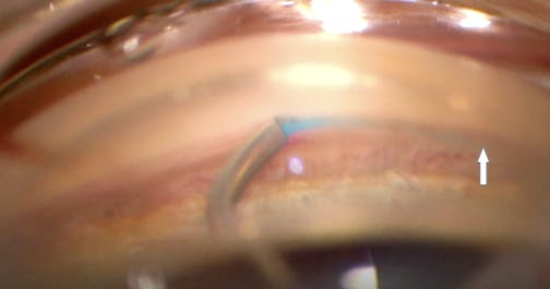 OMNI Ergo: Paying Attention to the Catheter