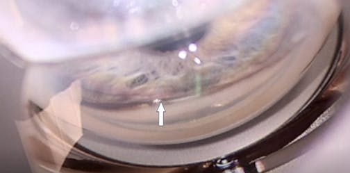 Cyclodialysis Closure Technique