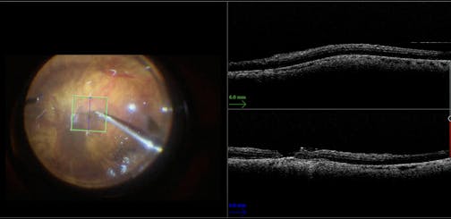 Dome-Shaped Maculopathy