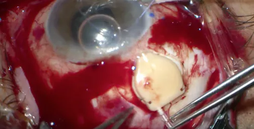Eyeplate and Eyewatch Glaucoma Drainage Device Implantation