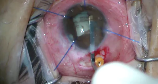 Cataract Surgery in Nanophthalmos