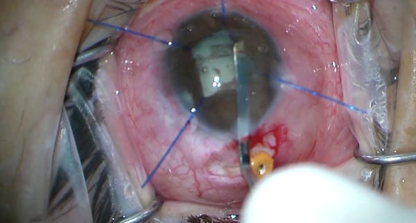 Cataract Surgery in Nanopthalmos thumbnail