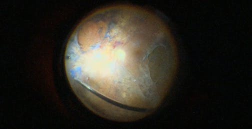 Severe Proliferation Around Retinectomies