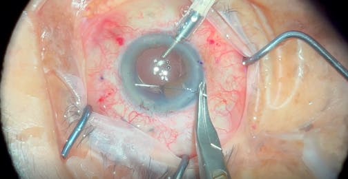 Ocular Trauma Repair for Aphakia, Mydriasis, and Glaucoma