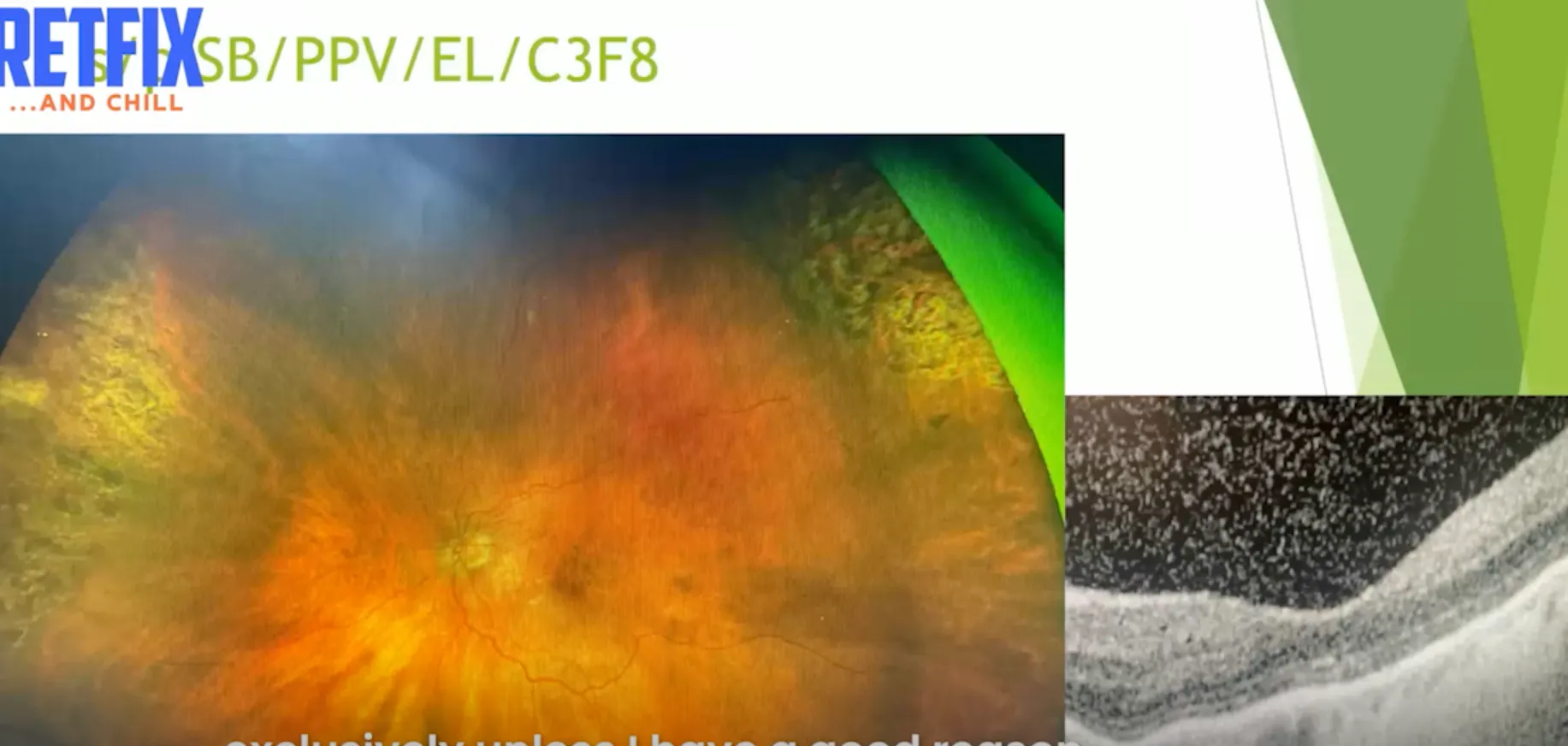 Ppv Optometry Episode 12 Part 1: Cases | PPV vs. SB/PPV for RRD - Eyetube