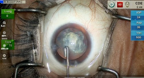 Posterior Polar Cataract