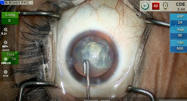 Posterior Polar Cataract thumbnail
