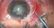Caution: Retinal Detachment