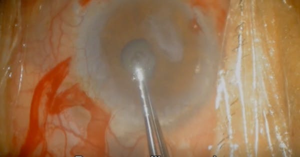 Small Uveitic Pupil thumbnail