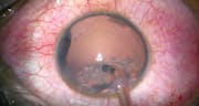 Traumatic Mydriasis