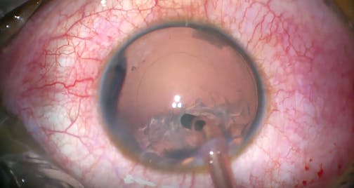 Traumatic Mydriasis