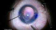Aniridia With Astigmatism